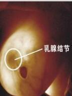 乳腺结节