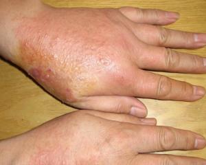 肛门接触性皮炎