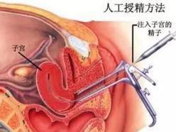 人工授精