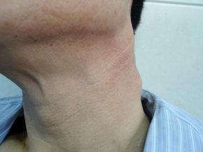 颈下淋巴结肿大