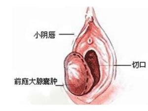 前庭大腺囊肿