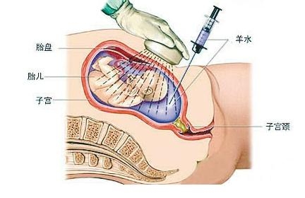 羊水穿刺