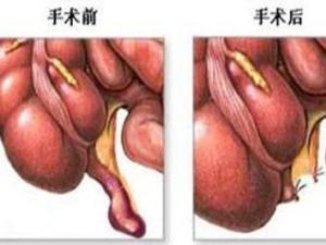 急性阑尾炎
