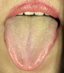 外文名whitish tongue意思舌色比正常人浅淡的舌象传染性无传染性常见
