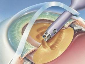 白内障手术