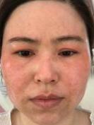 激素脸