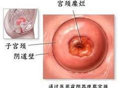 通过医用窥阴器观察宫颈