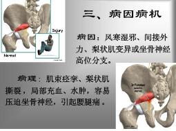 梨状肌综合征