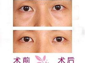 祛眼袋术