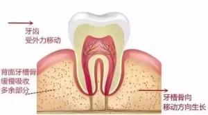 隐形牙齿矫正