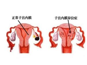 子宫内膜异位症