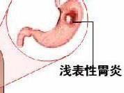 慢性浅表性胃炎