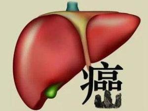 肝癌晚期