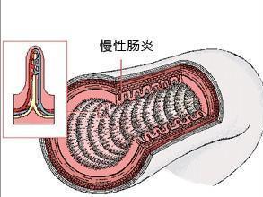 慢性结肠炎 搜狗百科