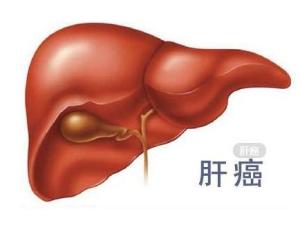 肝癌