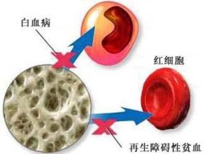 骨髓移植