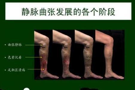 大隐静脉曲张 搜狗百科 大隐静脉曲张 搜狗百科