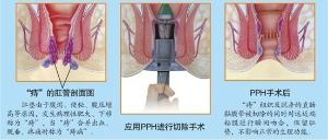 肛门瘙痒