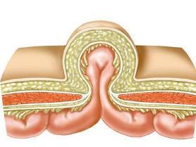 腹壁间层疝图片