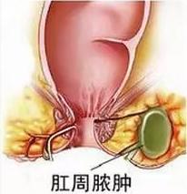 肛门脓肿