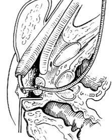 尿道会师牵引术