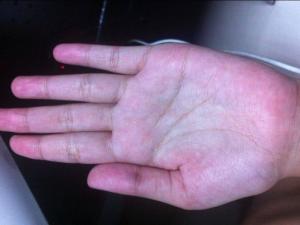 编辑1形成病因双手掌大,小鱼际和指尖掌面呈粉红色斑点和斑块主要症状