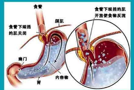 反流性食道炎 搜狗百科