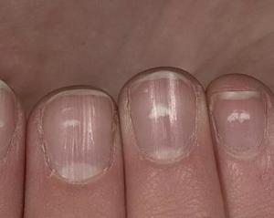 手指甲有白色斑点