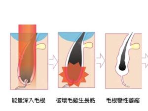 激光脱毛