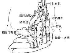 骨下动脉盗血综合症