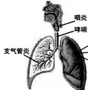 慢性咽炎