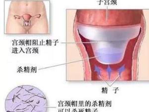 上环