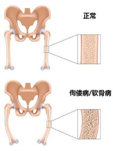 低血磷抗维生素d佝偻病本病多为性连锁遗传,亦可为常染色体显性或隐性