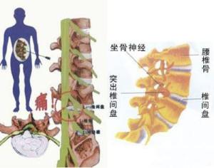 腰椎间盘突出症