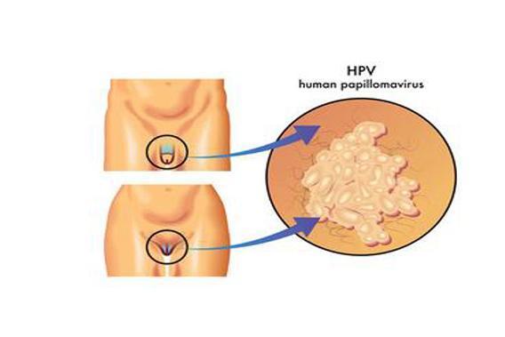 尿道口尖锐湿疣 搜狗百科