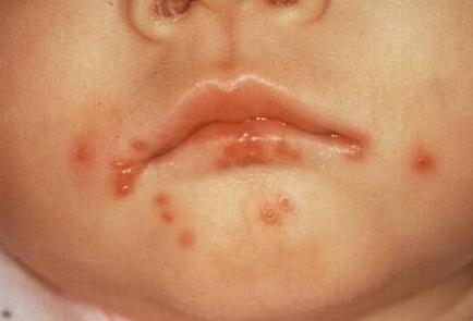 儿童口疱疹症状和图片图片