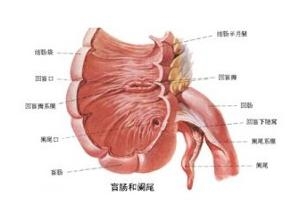 慢性阑尾炎