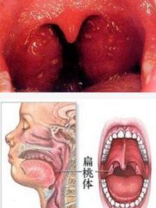 扁桃体发炎