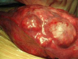 肝癌晚期腹水图片图片