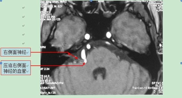 核磁显示右侧面神经在出脑干处被一血管压迫