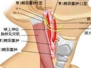 淋巴结发炎