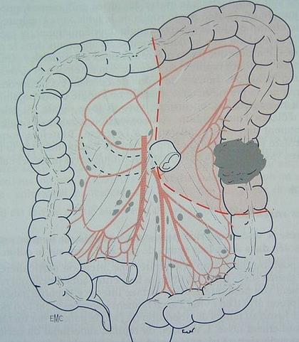 左半结肠癌手术步骤图图片