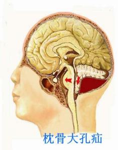 枕骨大孔疝