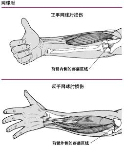 正反手网球肘