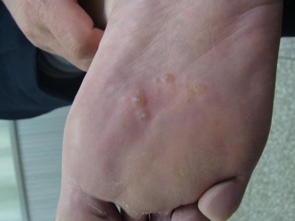 水疱型手足癣 搜狗百科 水疱型手足癣 搜狗百科