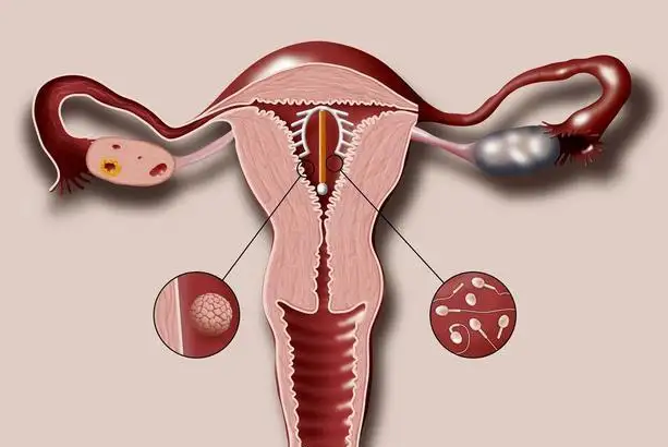 活性物质作用:宫内节育器可由金属铜制成,它可以通过宫腔内膜,宫腔液