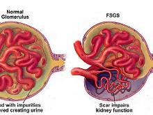 局灶节段性肾小球硬化
