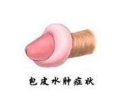 阴茎水肿