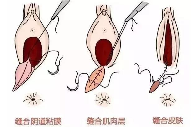 顺产撕裂肉线图片图片