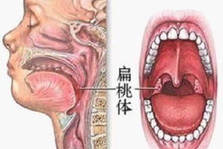 扁桃体 人体免疫系统的一部分 搜狗百科